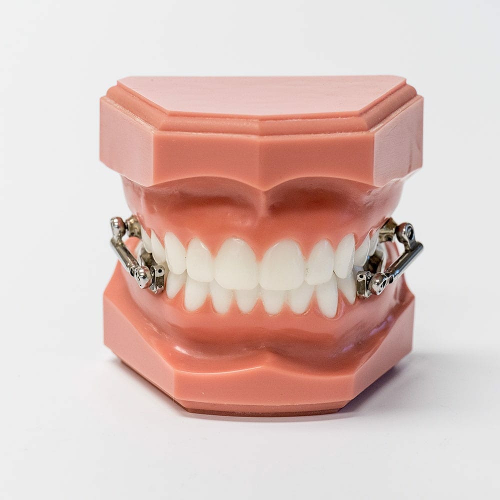 Herbst Appliance - Can Often Correct Severe Overbites without Braces