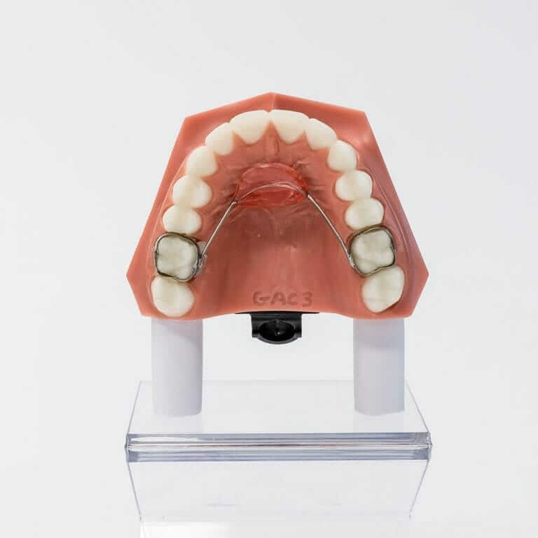 Lower Lingual Holding Arch and Nance Arch Maintain Spacing