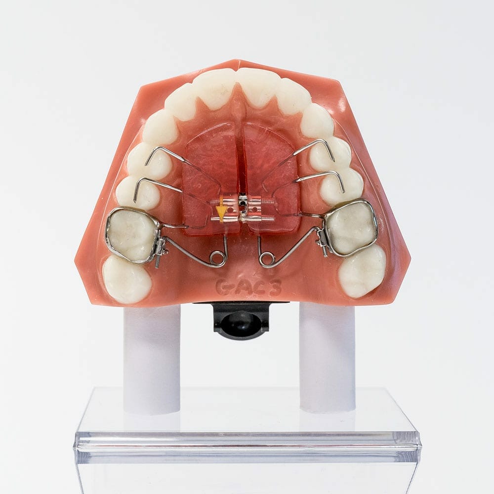 Herbst Appliance - Can Often Correct Severe Overbites without Braces