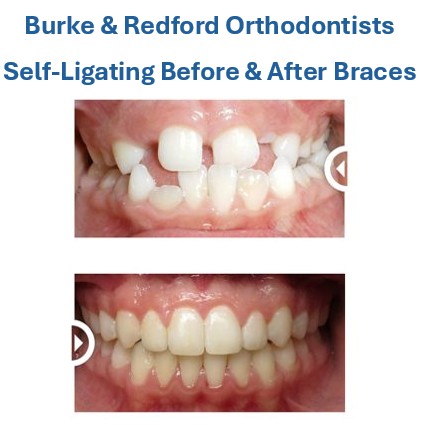 before and after self-ligating braces photos