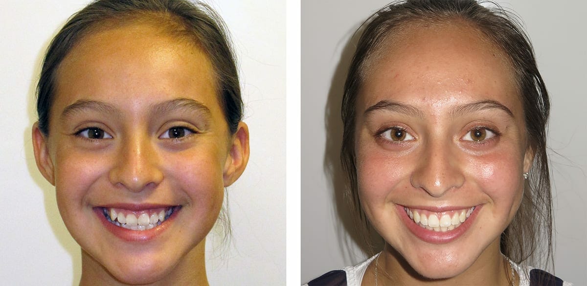 Best Orthodontist In Temecula For Over 30 Years For Kids And Adults
