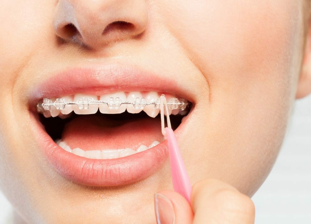 What Are Elastic Bands For Braces? How To Put Elastic Rubber Bands On.