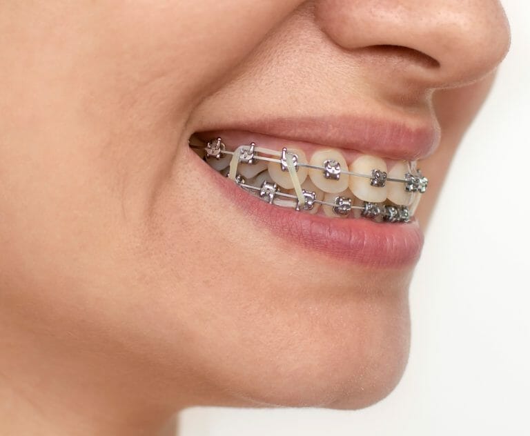 What Are Elastic Bands For Braces? How To Put Elastic Rubber Bands On.