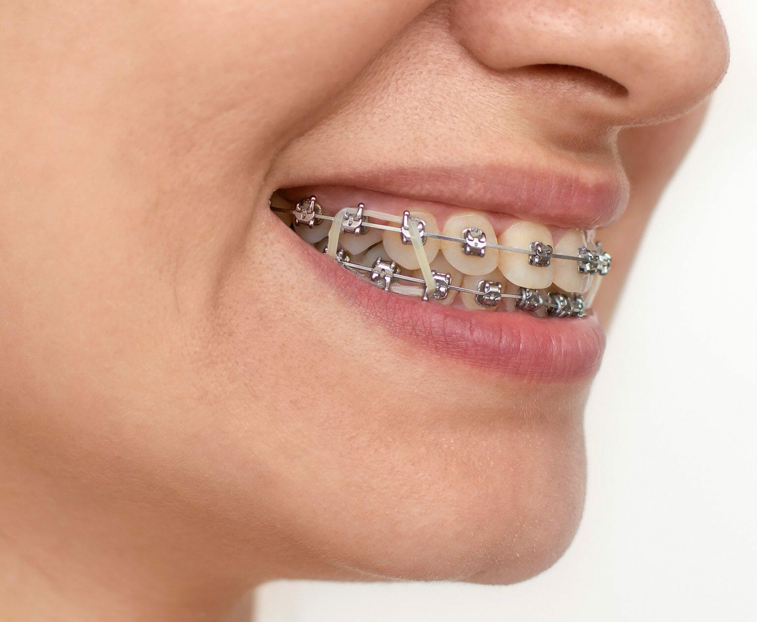 What are Elastic Bands for Braces? How to Put Elastic Rubber Bands On.