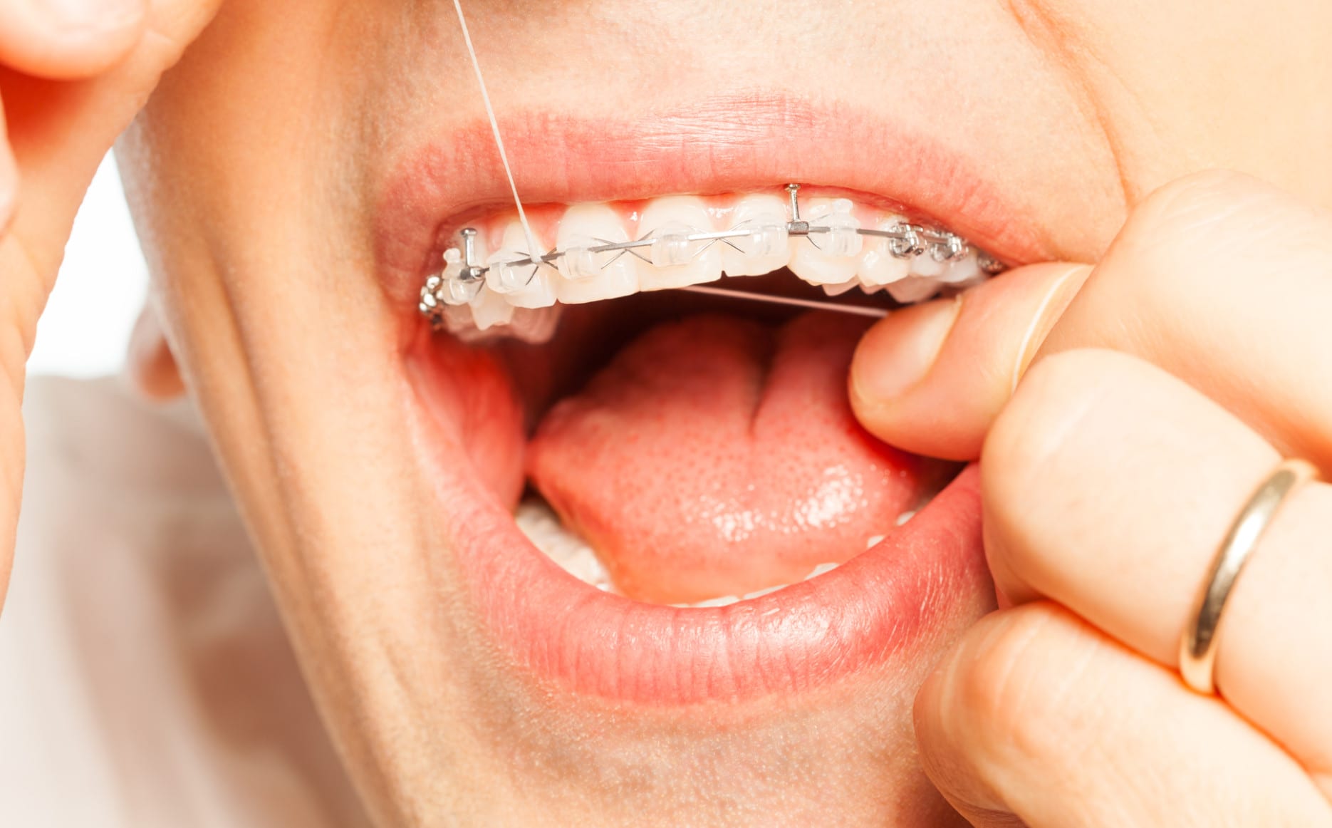 how to use dental floss with braces