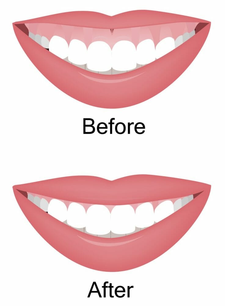 Diode Laser Gum Contouring After Braces Burke & Redford Orthodontists