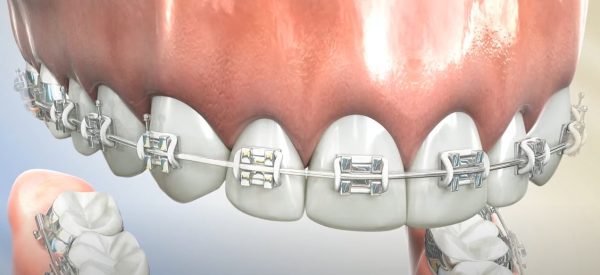 How is IPR Performed with Braces?