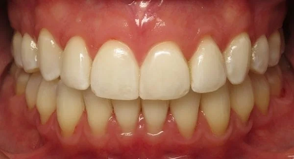Invisalign for Adults Orthodontist Temecula After Picture