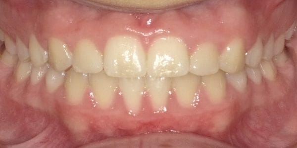 Invisalign Cost - Before and After Pictures