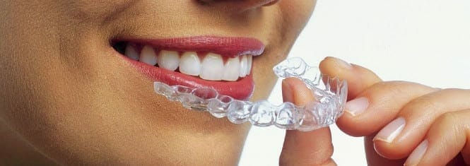 invisalign clear aligners