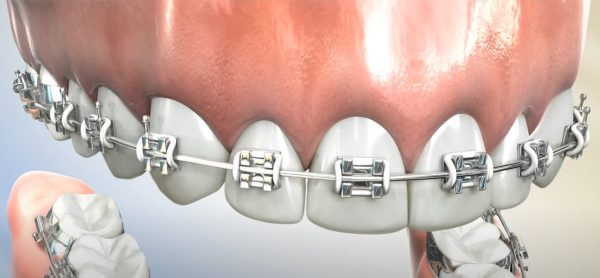 IPR in Ortho with Braces