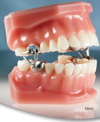 MARA appliance orthodontic