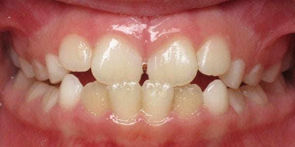 Crossbite Orthodontic Treatment