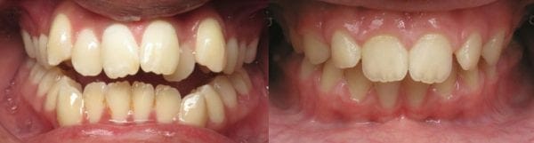 open bite before and after pictures