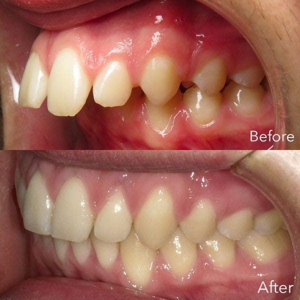 overbite before and after pictures