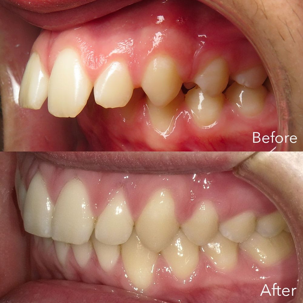 overbite before after