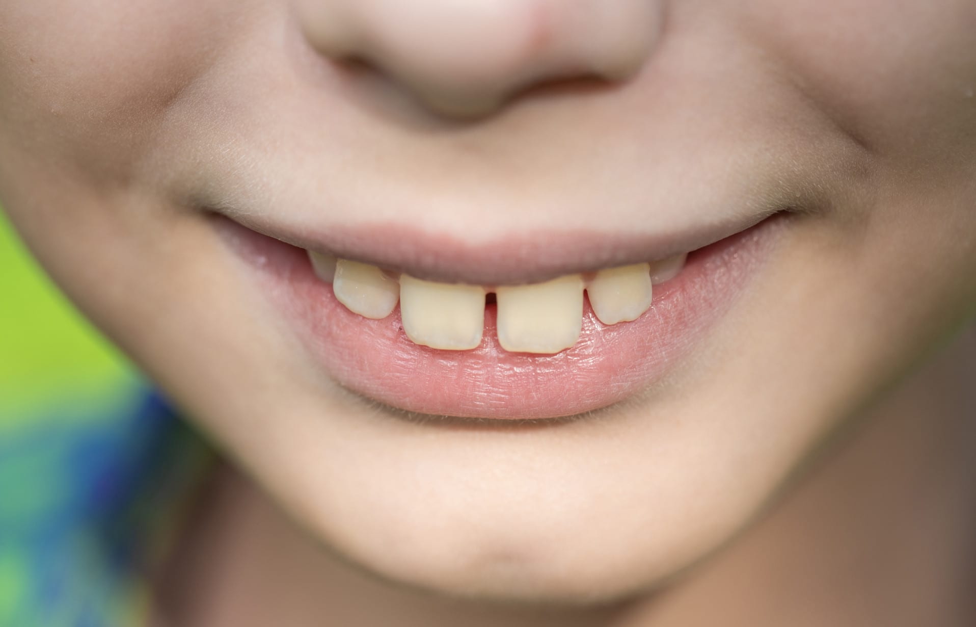 What Is An Overbite? Is an Overbite Bad for Your Teeth?