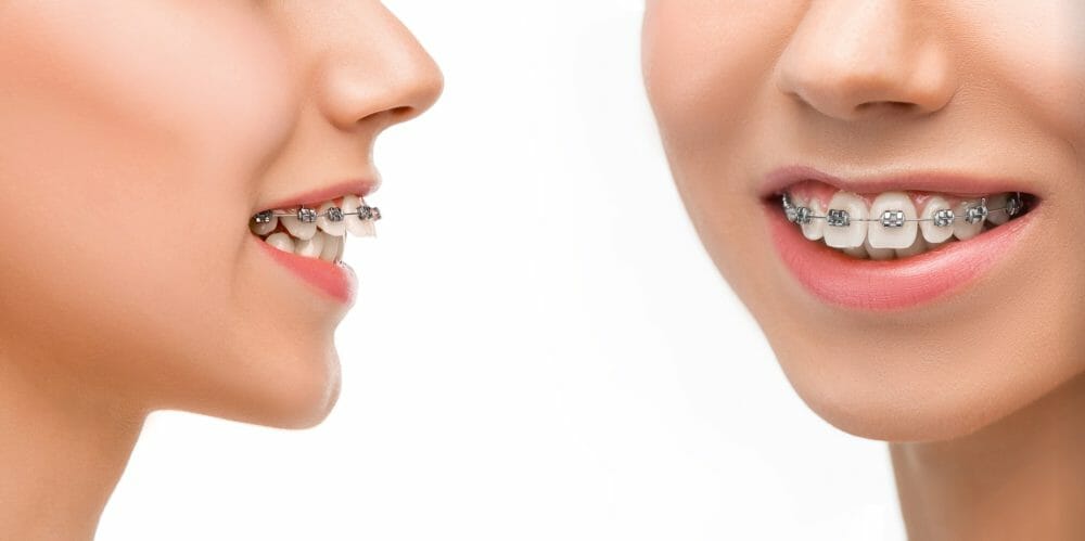 Overbite Treatment with Metal Braces
