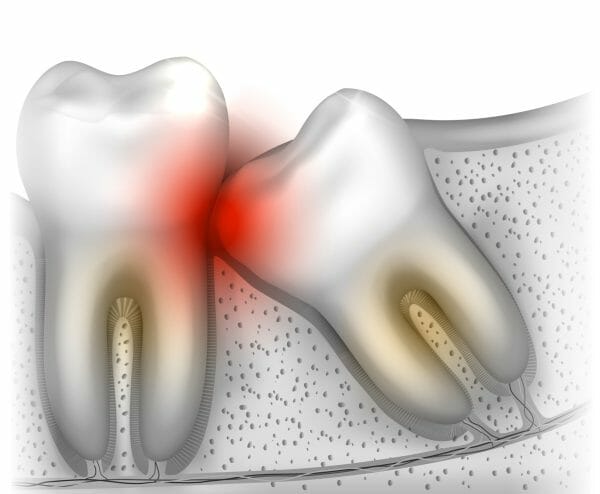 overeruption tooth
