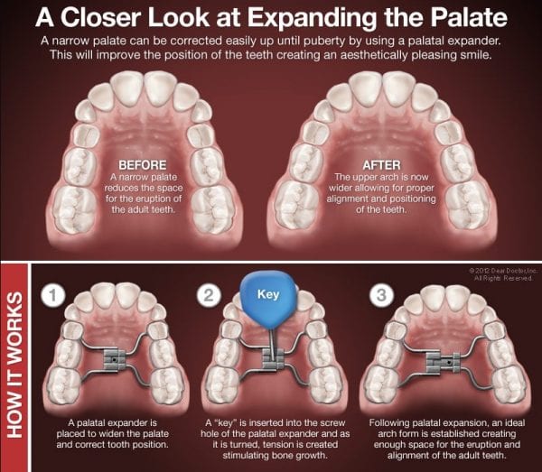 palatal expander before and after