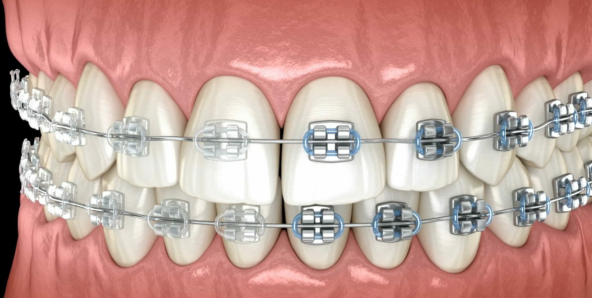 Class III Malocclusion Treatment Pediatric Orthodontist