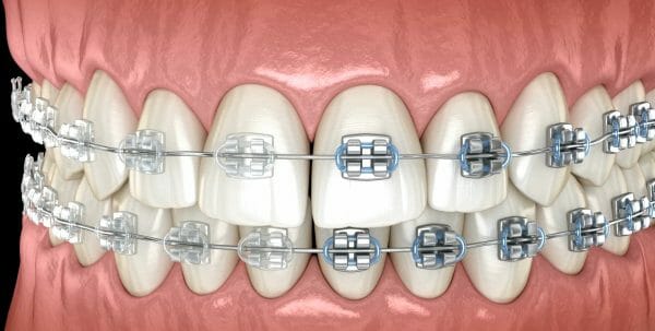 Self-Ligating Metal and Ceramic Braces for Teens and Children