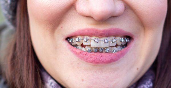 Traditional Braces that Cause Discomfort, Oral Hygiene Difficulties, Esthetic Concerns and More Frequent Adjustments than Self-Ligating Braces that Burke & Redford Orthodontists Offer.