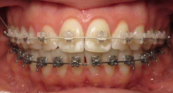 Self-Ligating Clear Ceramic and Metal Braces Patient at Burke & Redford Orthodontists