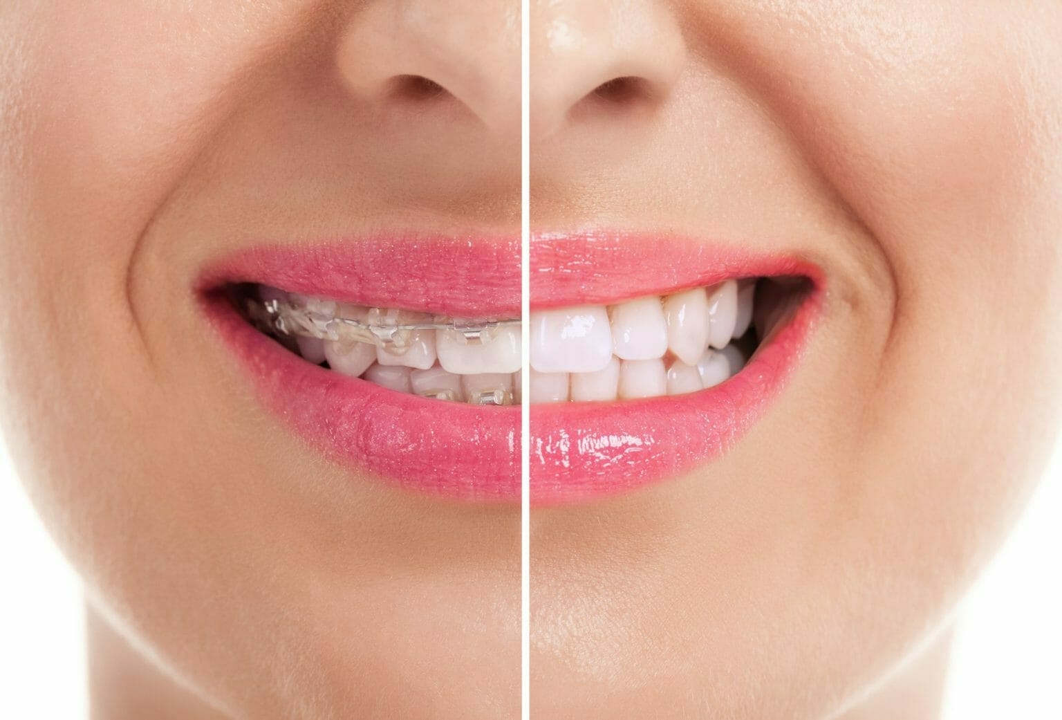 Whitening Teeth After Braces