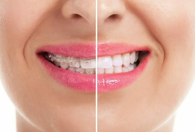 Whitening Teeth After Braces