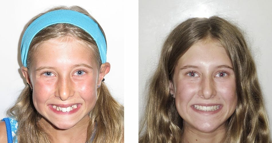 overjet before and after braces treatment