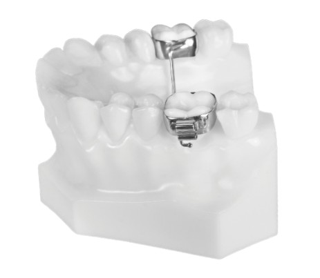 Transpalatal Arch Orthodontic Appliance