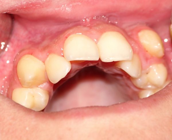 transposition malocclusion adjacent teeth