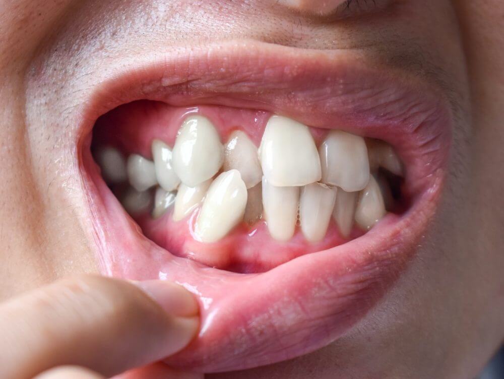 Transposition Malocclusion Orthodontic Treatment