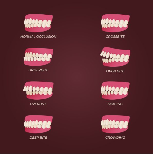 Types of Malocclusions - Bites