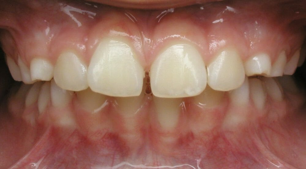 Reverse Pull Headgear Orthodontist for an Underbite