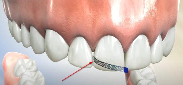 Burke & Redford Orthodontists Use IPR to Create Minimal Space for Braces.