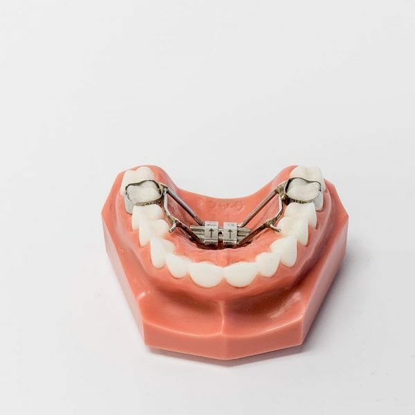 Banded Palatal Expander