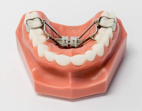 Banded Palatal Expander Banded Palatal Expander