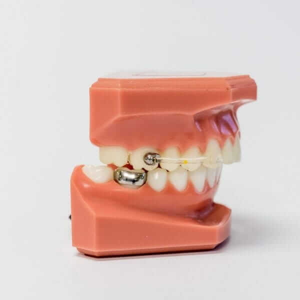 Carriere Distalizer Orthodontic Appliance Carriere Distalizer Orthodontic Appliance