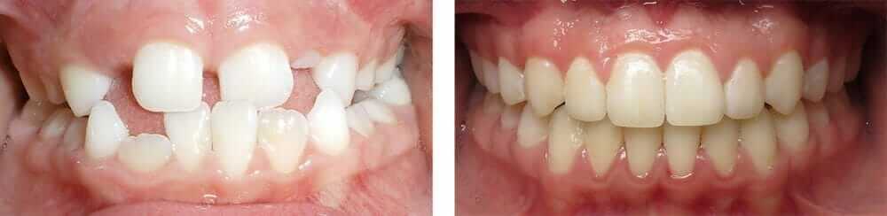 Invisalign for Teenagers Temecula