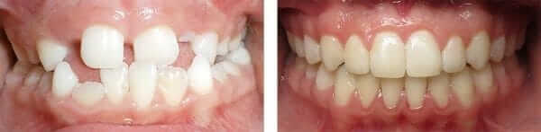 Invisalign for Teenagers Temecula