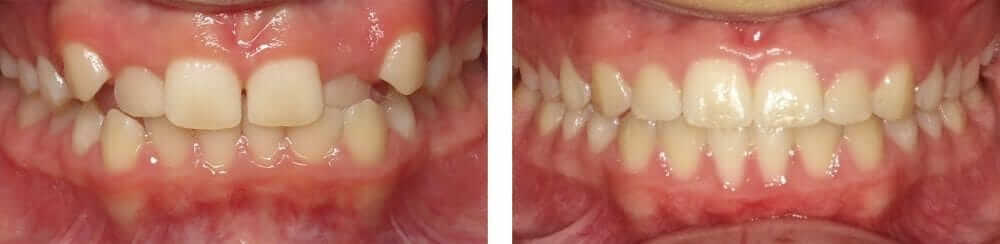 Invisalign for Teens in Temecula and Lake Elsinore Invisalign for Teens in Temecula and Lake Elsinore