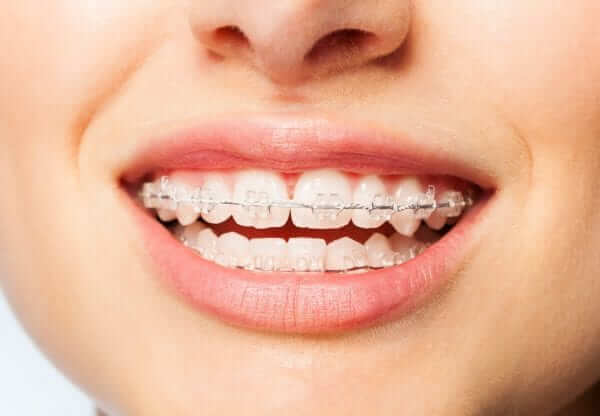 Clear Braces Orthodontist in Temecula and Lake Elsinore Clear Braces Orthodontist in Temecula and Lake Elsinore