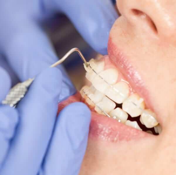 best ceramic braces orthodontist temecula