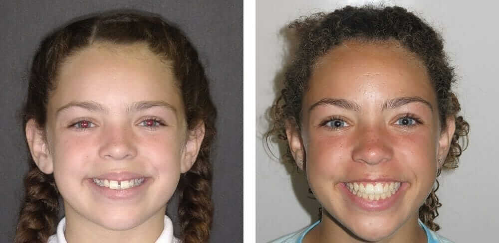 Braces for Kids in Temecula and Lake Elsinore Braces for Kids in Temecula and Lake Elsinore