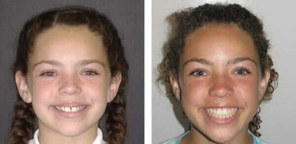 best child orthodontist before and after braces off day
