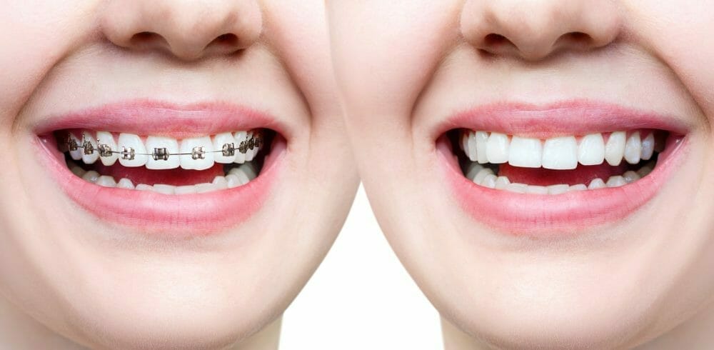 best teeth whitening after braces best teeth whitening after braces