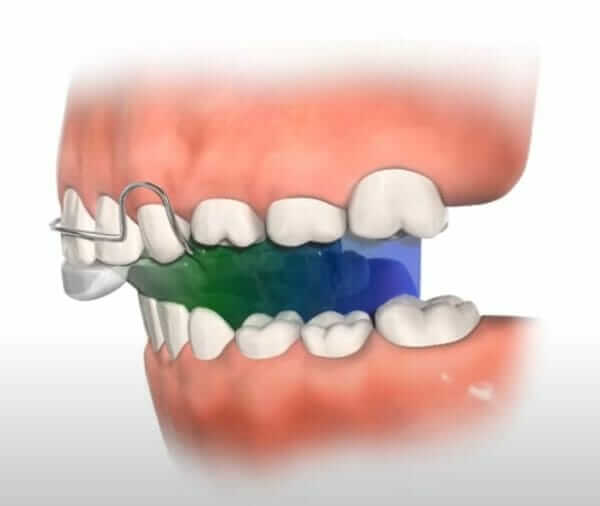 bionator appliance
