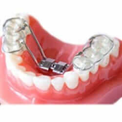 Bonded Palatal Expander Bonded Palatal Expander